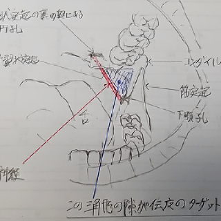 2020年9月25日 効く麻酔、さらに痛くなく（なるべく）効く下顎孔伝達麻酔