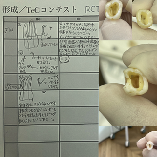 2023年9月24日 根管拡大コンテスト