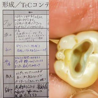 2023年10月7日 大臼歯RCT4本目