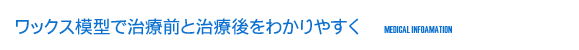 ワックス模型で治療前と治療後をわかりやすく